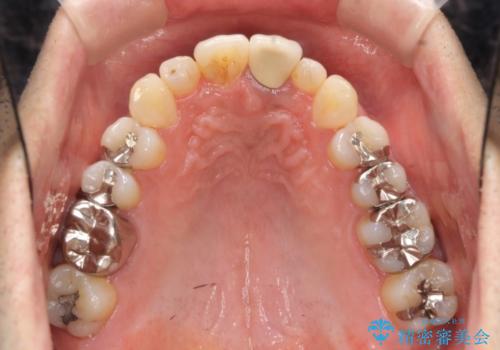 [マウスピース矯正]インビザラインによる前歯のガタつき改善の治療後