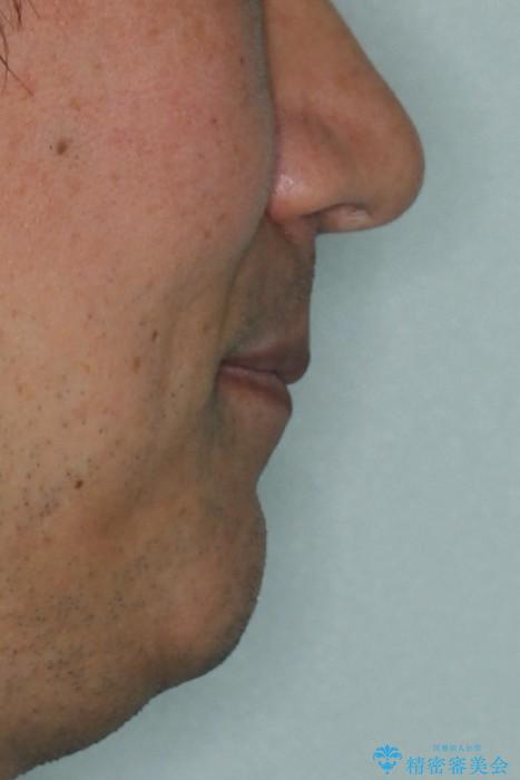 ワイヤー矯正による出っ歯の治療　表の審美装置で見た目と機能性を両立の治療後（顔貌）
