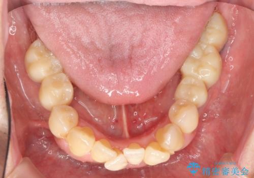 インプラント・再生治療を応用した全顎的重度歯周病治療の治療中