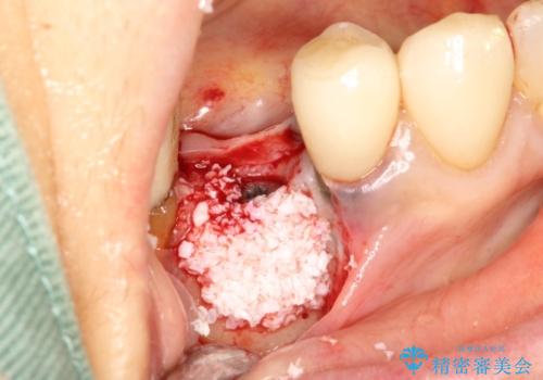 歯根破折で抜歯を余儀なくされた歯のインプラント治療の治療中