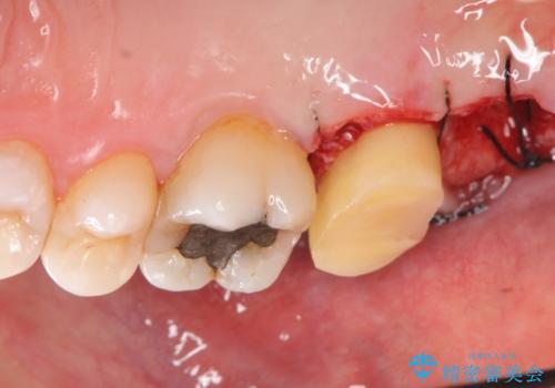 [骨縁に達する深い虫歯] 歯の挺出・歯周外科を応用し抜かずに残す治療②の治療前