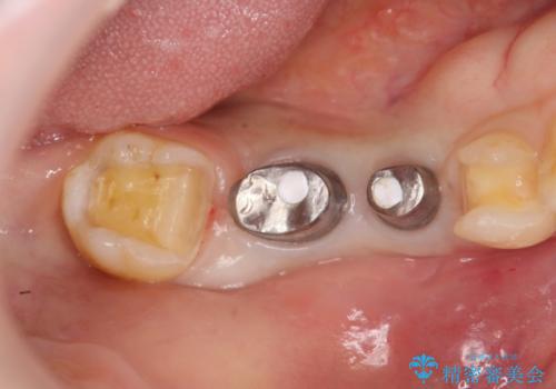 奥歯のインプラント　セラミック修復の治療中