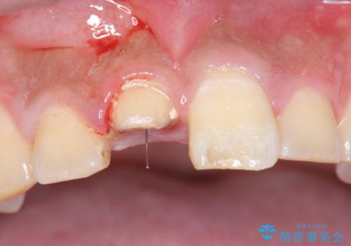 [ 前歯 審美回復 ] 治療途中からの転院　天然歯を模したセラミッククラウンの治療前