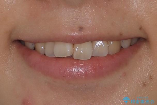 インビザライン・非抜歯　出っ歯とガタつきの矯正治療の治療前（顔貌）