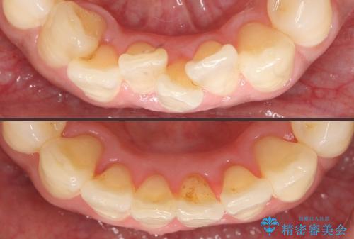 [マウスピース矯正]インビザラインによる前歯のガタつき改善