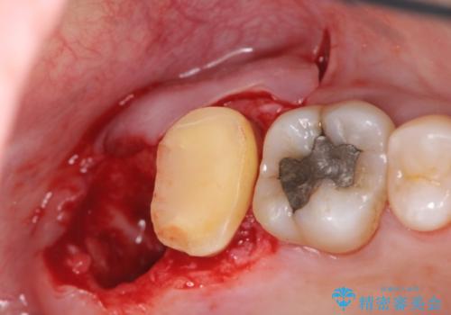 [骨縁に達する深い虫歯] 歯の挺出・歯周外科を応用し抜かずに残す治療①の治療後