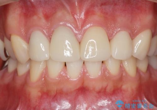 多発した前歯の虫歯　emaxクラウンによる治療の治療後