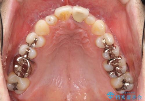 [マウスピース矯正]インビザラインによる前歯のガタつき改善の治療前