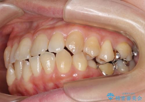 小矯正を併用し機能性・清掃性を高めた臼歯部ブリッジ治療の治療前