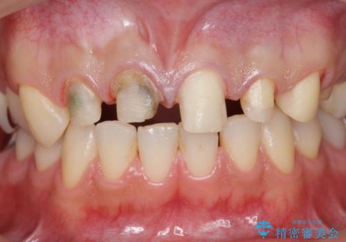 多発した前歯の虫歯　emaxクラウンによる治療の治療中
