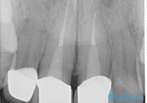 前歯部補綴　(黒ずみの改善)の治療後