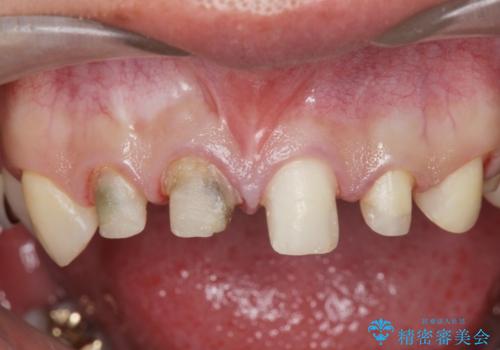 多発した前歯の虫歯　emaxクラウンによる治療の治療中