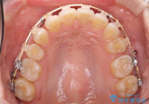 出っ歯の治療　前から5番目の歯を抜歯　すれ違い咬合もの治療中