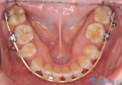 出っ歯の治療　前から5番目の歯を抜歯　すれ違い咬合もの治療中