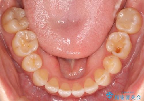出っ歯の治療　前から5番目の歯を抜歯　すれ違い咬合もの治療後