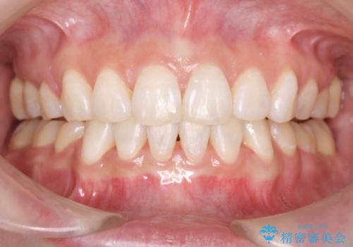 出っ歯の治療　前から5番目の歯を抜歯　すれ違い咬合もの治療後
