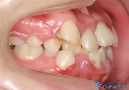 予防歯科　歯磨き指導とスケーリング、SRPでここまでよくなりますの治療前
