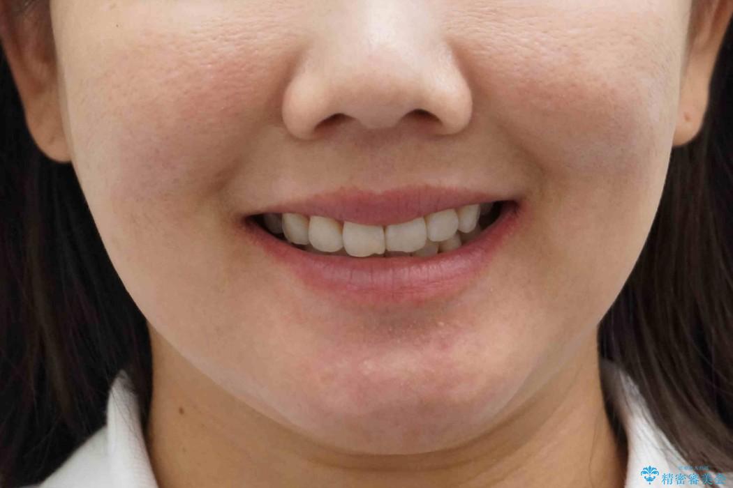 出っ歯の治療　前から5番目の歯を抜歯　すれ違い咬合もの治療後（顔貌）