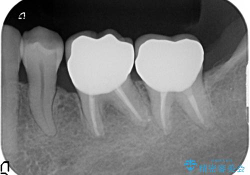 感染を生じている奥歯の根本的な治療→かみ合わせの回復の治療後