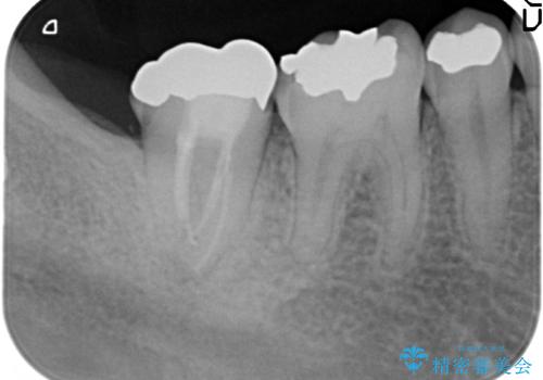 咬むと痛い　根管治療のやり直しと歯周外科を含む徹底的な治療の治療前