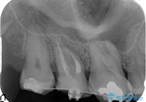 [骨縁に達する深い虫歯] 歯の挺出・歯周外科を応用し抜かずに残す治療①の治療中