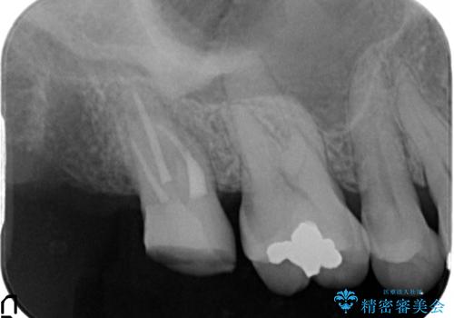 [骨縁に達する深い虫歯] 歯の挺出・歯周外科を応用し抜かずに残す治療②の治療中