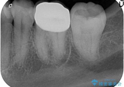 奥歯の虫歯　神経を取らずに治療の治療後