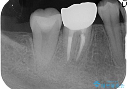 被せものが外れやすい状態を歯周外科で改善する　根管治療もやり直すの治療後