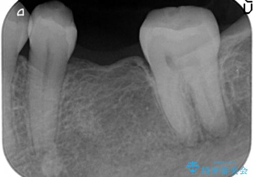 小矯正を併用し機能性・清掃性を高めた臼歯部ブリッジ治療の治療中