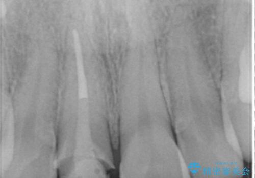 [ 前歯 審美回復 ] 治療途中からの転院　天然歯を模したセラミッククラウンの治療中
