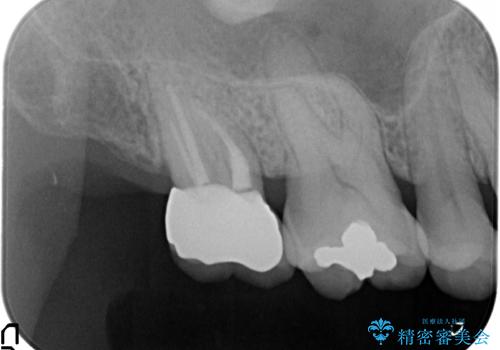 [骨縁に達する深い虫歯] 歯の挺出・歯周外科を応用し抜かずに残す治療②の治療後