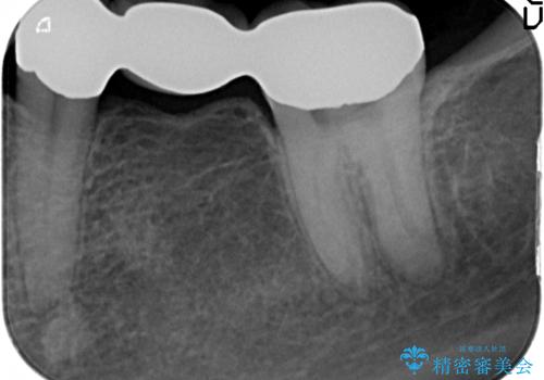 小矯正を併用し機能性・清掃性を高めた臼歯部ブリッジ治療の治療後