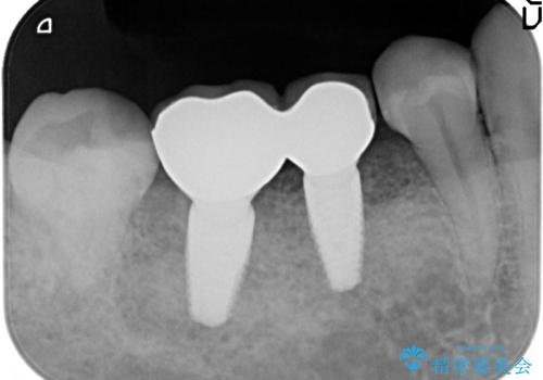 奥歯のインプラント　セラミック修復の治療後