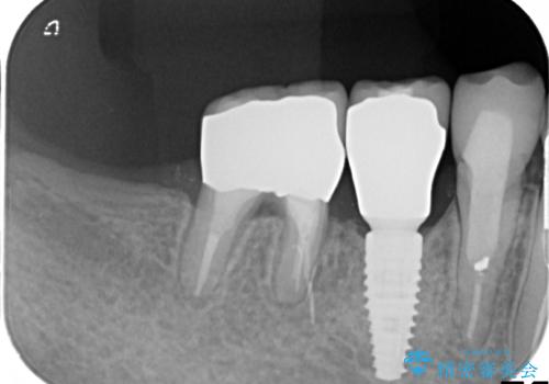歯根破折で抜歯を余儀なくされた歯のインプラント治療の治療後