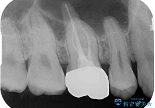 根管治療後の奥歯のセラミッククラウン治療　歯肉からの出血が改善の治療後