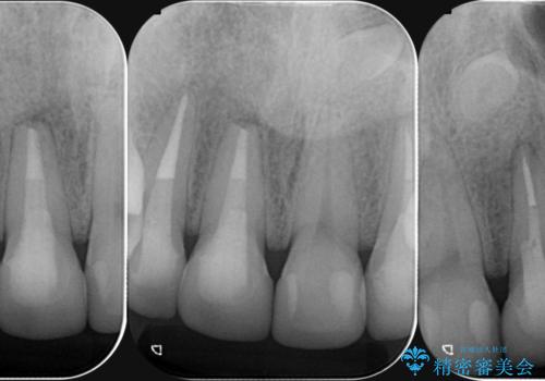 多発した前歯の虫歯　emaxクラウンによる治療の治療後