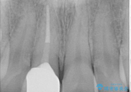 [ 前歯 審美回復 ] 治療途中からの転院　天然歯を模したセラミッククラウンの治療後