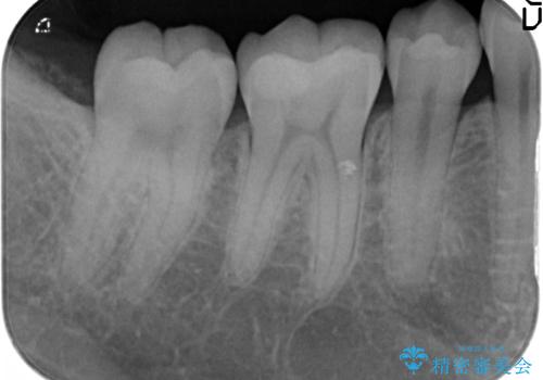 セラミックインレー修復　虫歯をとって白い歯への治療後