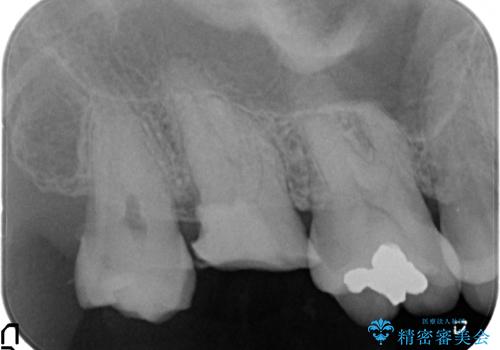 [骨縁に達する深い虫歯] 歯の挺出・歯周外科を応用し抜かずに残す治療②の治療前