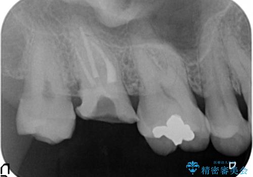 [骨縁に達する深い虫歯] 歯の挺出・歯周外科を応用し抜かずに残す治療①の治療中