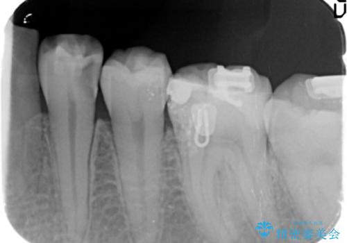 奥歯の虫歯　神経を取らずに治療の治療前