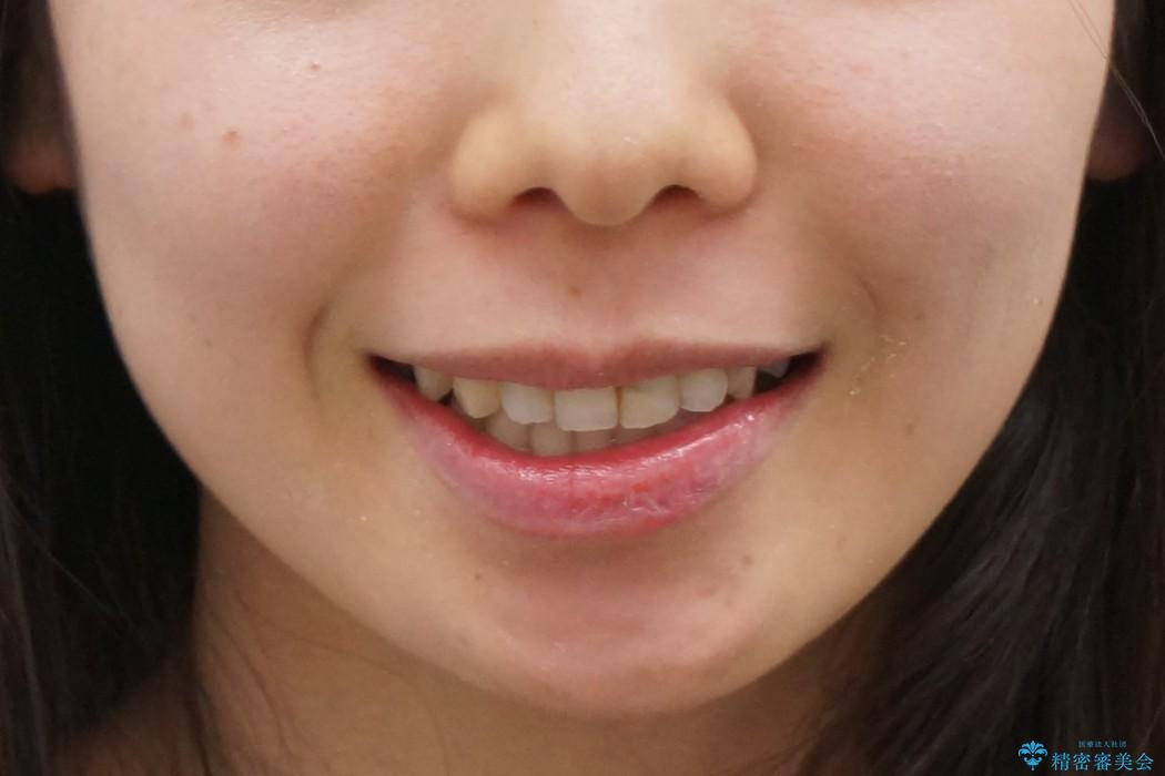 出っ歯の治療　最小限の抜歯の治療後（顔貌）