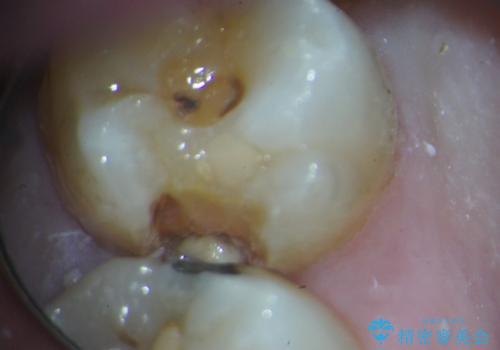 [骨縁に達する深い虫歯] 歯の挺出・歯周外科を応用し抜かずに残す治療①の治療前