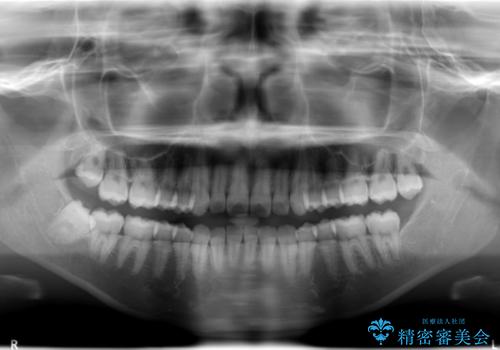 上下裏側矯正　フルリンガルによる上下前歯前突の歯列矯正の治療前