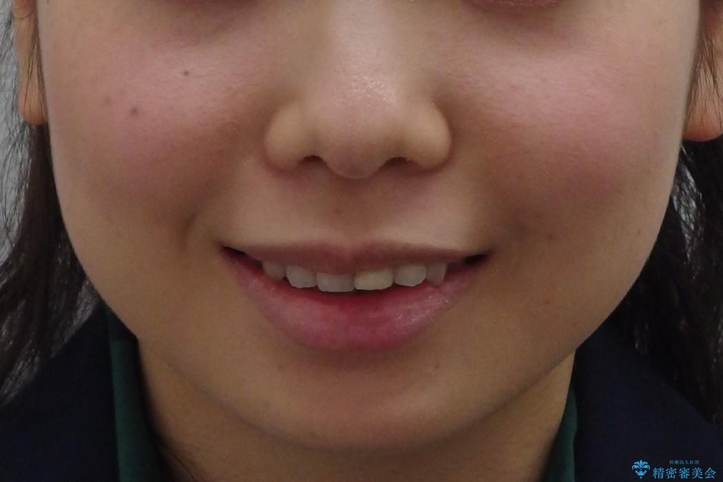 出っ歯の治療　最小限の抜歯の治療前（顔貌）