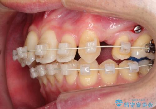 ワイヤー矯正による出っ歯の治療　表の審美装置で見た目と機能性を両立の治療中