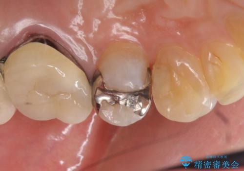 虫歯治療　銀歯からセラミックインレーへの治療前