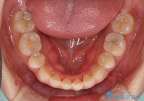 前歯の反対咬合を改善　フルリンガルの抜歯矯正の治療後