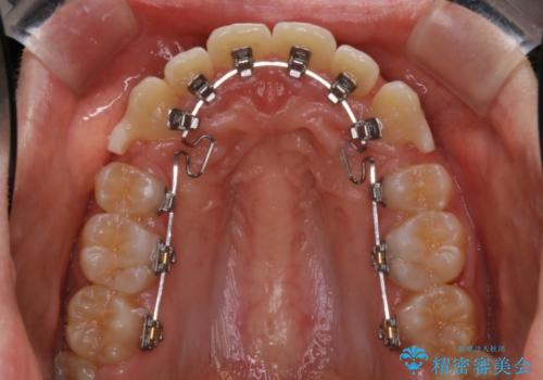 上下裏側矯正　フルリンガルによる上下前歯前突の歯列矯正の治療中
