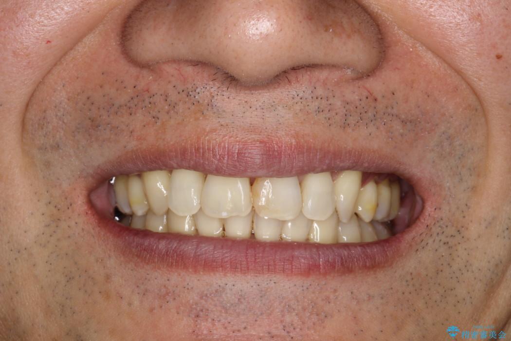 ワイヤー矯正による出っ歯の治療　表の審美装置で見た目と機能性を両立の治療後（顔貌）
